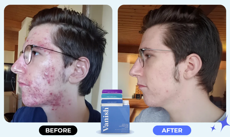 Vanish DrySerum customer reviews.